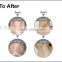 Pores Refining Screen Logo Customized Ipl Hair Removal Ipl Bikini Shr Hair Removal Machine Ipl Hair Removal Machine Improve Rough