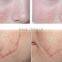 Fractional CO2 Laser Deep wrinkle removal laser vaginal tightening laser