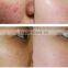 Acne Scar Removal Laser Laser CO2 Resurfacing Machine Treat Telangiectasis From With CE RF Portable Design Fractional Producers Face Whitening