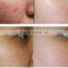 fractional c02 laser acne treatment POP-FC3