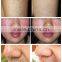 new professional portable 980 nm diode laser red blood vessels removal