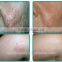 best effective evlt 980nm laser laser vascular therapy machine/vein removal 980nm treatment laser equipment/vein stopper device