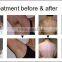 professional ipl shr beauty machine for brown black hair removal