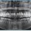 Digital Dental Panoramic Radiology Machine