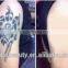 Telangiectasis Treatment Professional Tattoo Removal 1 HZ Q-Switched Nd Yag Laser Equipment