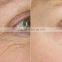 2016 hot Micro Needle RF/fractional system/scar wrinkle removal/skin whitening/tightening/acne