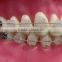 Orthodontic Teeth Model