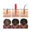 korean alopecia rogaine hair regrowth horse hair growth tonic laser system machine instrements therapy equipment in pakistan