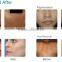 Best IPL SHR system with CE certificate Apolomed model HS-665