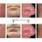 New Year Trending Hot Products Vascular Spider Vein Removal/ Laser Veins Removal Machine For Sale