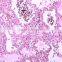 Individual slides you can choose from Educational human tissue pathology of Cancer lymph node metastasis prepared slides