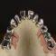 PFM-Bridges-Crowns  China Dental Laboratory - Outsourcing Dental Lab