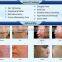 New radio frequency microneedling RF fractional mesotherapy machine