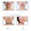 Therapy Device for V Shape Face/Chin Heating Face Massage for Spa Care
