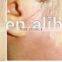 benign familial pemphigus treatment laser machine/co2 laser machine for surgical