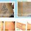 D003 professional laser tattoo removel machine / tattoo equipment