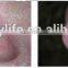 980nm diode laser vascular removal machie/spider vein removal device