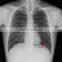 HC-D017 CCD Based Uc-Arm Digital X-ray Machine /X Ray Equipment/Digital Machine
