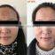 Strong power EO q-switch laser pigmentation removal