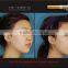 Professional Hot!!!!carboxy treatment instrument, carboxy treatment