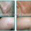 Newest technology veins removal skin treatment 980nm diode laser vascular removal machine