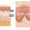 Professional Q switch nd yag laser tattoo removal mchine with 1064nm 532nm