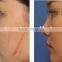 CE approved good effective Co2 laser machine for scar removal and pore remover