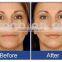 Newest 3heads ultrasound HIFU face lift