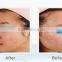 acne removal,skin rejuvenation, scar removal light therapy system