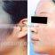 professional Q Switched nd yag laser/salon use q switched nd yag/fast effect q switched nd yag laser