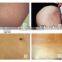 Wart Removal Salon Vertical RF Co2 Wrinkle Removal Fractional Laser Skin Treatment Machine Sun Damage Recovery Sun Damage Recovery