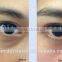 Eye bag removal machine/ home beauty device /RF eye beauty machine