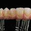 Full-arch Implant Bridge Prosthesis, Implant Denture Framework, Implant Prosthesis, Laboratoire Dentaire, Dentallabor, Laboratorio Dental, Dental Laboratory, Shenzhen LJ Dental Lab China