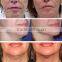Real Hifu Face Lifting Machine Wrinkle Removal Ultra Impact Pixel RF Beauty Salon and Spa Equipment
