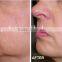 Vertical Apolomed 1540nm fractional for laser skin resurfacing and scars