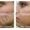 2016 New Product pdt beauty machine and equipment skin care Home Care Technology