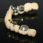 Telesope Crown, Dental Telescope Denture, Dental Prosthesis, Laboratoire Dentaire, Dentallabor, Laboratorio Dental, Dental Laboratory, Shenzhen LJ Dental Lab China