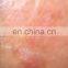 980nm diode laser vascular removal beijing manufacturer, spider vein removal 980nm diode laser