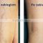 Portable Spider Vein Removal Beauty Machine/Home Treatment Spider Veins Images