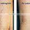 Spider Vein Removal Vascular Removal Mini Machine/Home Treatment Spider Veins Images