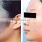 Haemangioma Treatment Q-Switch ND Yag Laser System With Medical CE+laser Tattoo Removal Machine Varicose Veins Treatment