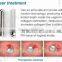 2015 Best Vaginal Rejuvenation / Striae Gravidarum Removal / RF Fractional Co2 Laser Vaginal Tightening