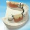 PFM Porcelain Fused To Metal Crown From Outsourcing Dental Lab