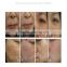 skin care 1550nm fractional acne scar removal beauty anti aging machines skin lightening