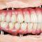Full Zirconia Bridge Design  MYY Dental Lab - Outsourcing China Dental Lab