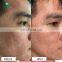 facial clean skin rejuvenation collagen stimulation dermabrasion skin rejuvenation device