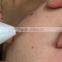 liquid co2 laser plasma pen for spots freckle mole removal