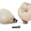 Custom Abutments Esthetic Implant Prosthesis China Dental Lab