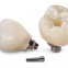 Custom Zirconia Abutment Porcelain Fused to Metal Bridge Made in China Dental Lab