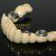 Telesope Crown, Dental Telescope Denture, Dental Prosthesis, Laboratoire Dentaire, Dentallabor, Laboratorio Dental, Dental Laboratory, Shenzhen LJ Dental Lab China
